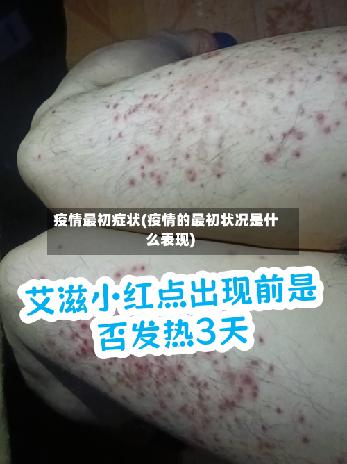 疫情最初症状(疫情的最初状况是什么表现)-第2张图片