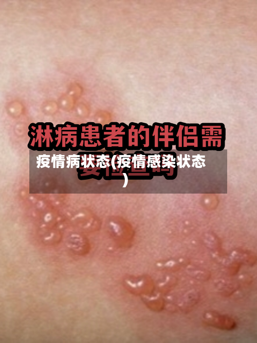 疫情病状态(疫情感染状态)